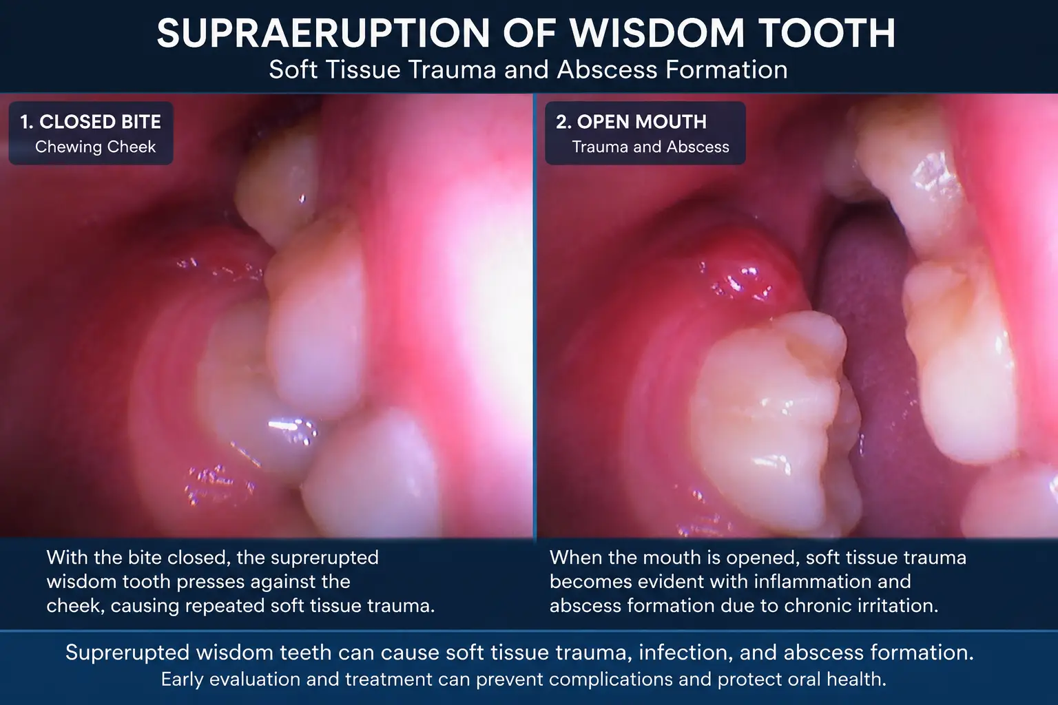 Intraoral photos showing supraerupted wisdom tooth causing cheek trauma and soft tissue abscess formation.