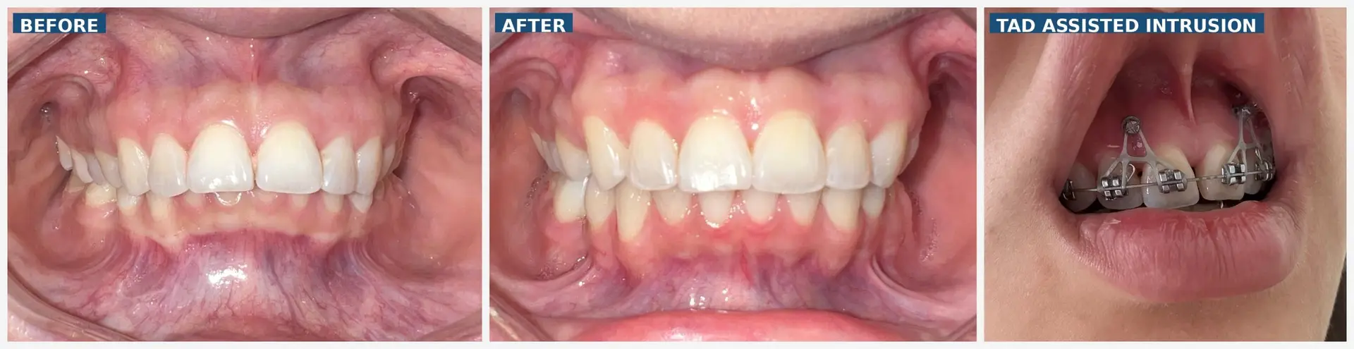 Before and after orthodontic treatment correcting deep overbite, narrow arches, excessive gingival display, and TMJ-related bite issues using braces and anterior TAD-assisted intrusion.