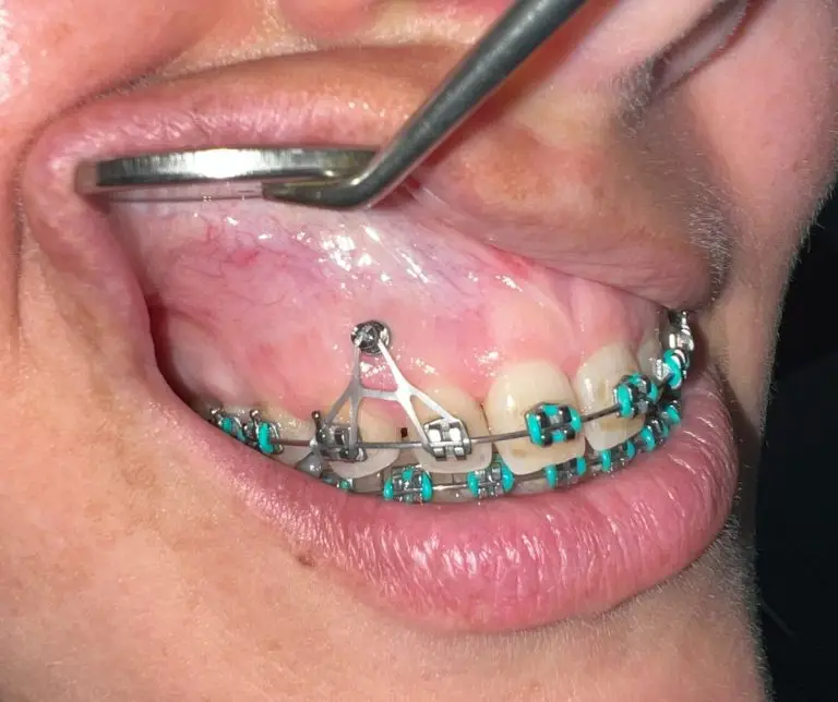 Intraoral photo of orthodontic TAD mini-implant connected to braces for skeletal anchorage and controlled tooth movement.