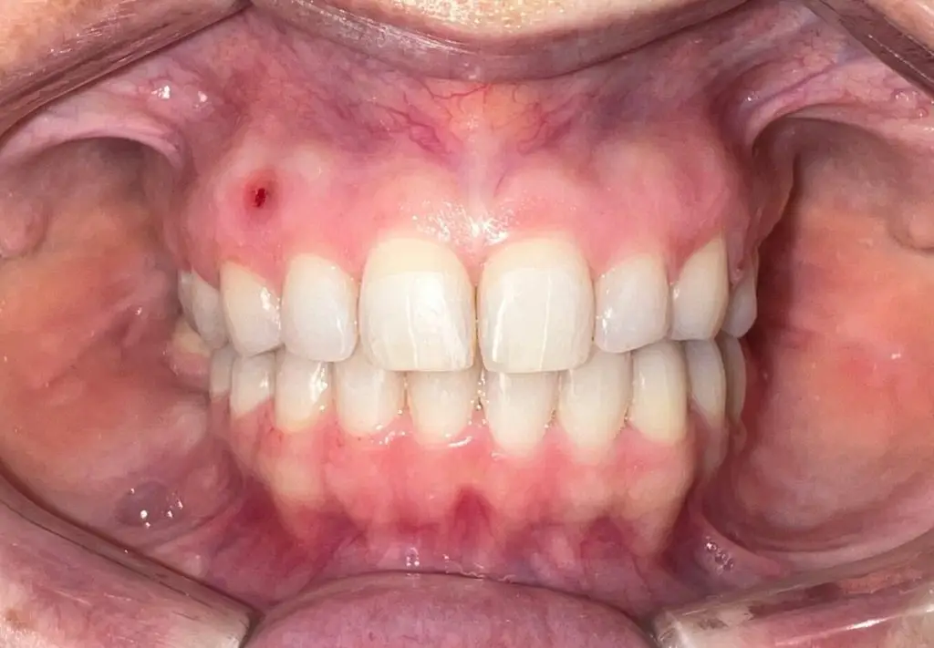 Intraoral photo showing small healing opening immediately after orthodontic TAD removal.