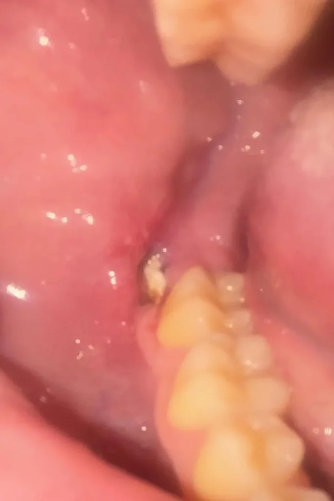 Bone sequestrum emerging from healing wisdom tooth extraction site after oral surgery