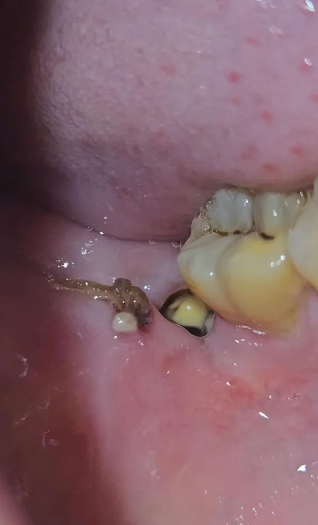 Food trapped in a healing wisdom tooth extraction socket with dissolvable stitches during postoperative recovery