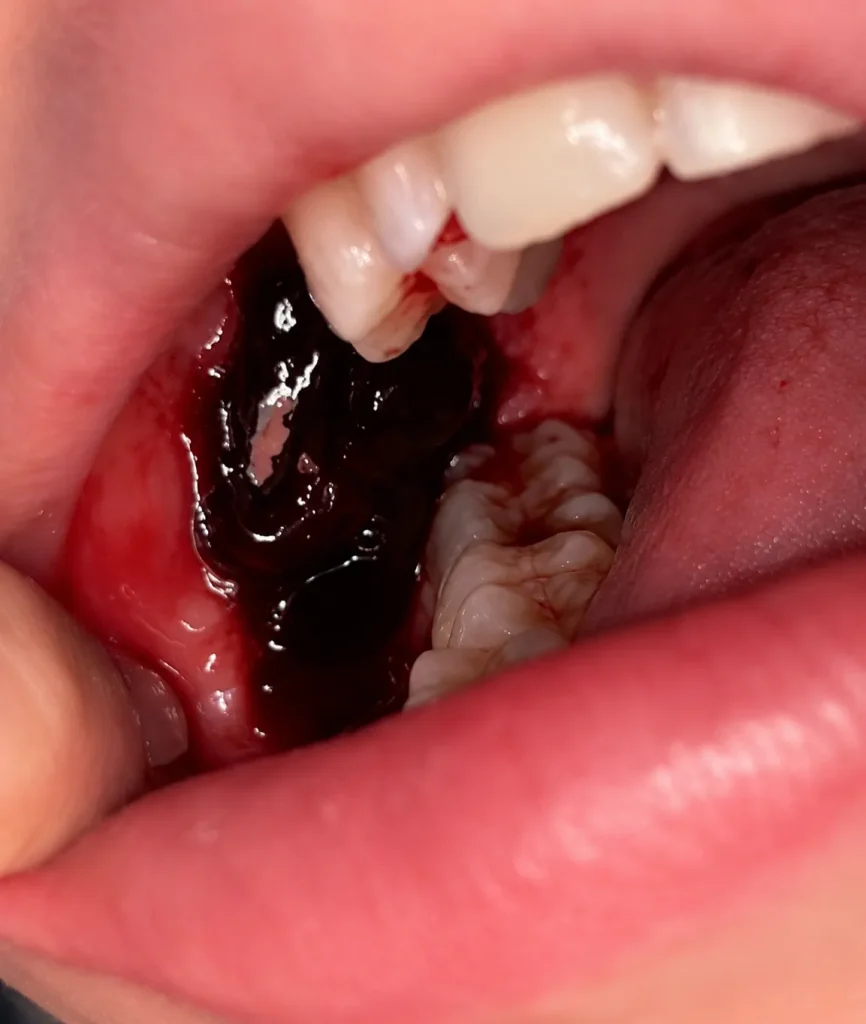Large blood clot known as a liver clot forming after wisdom tooth extraction during early healing