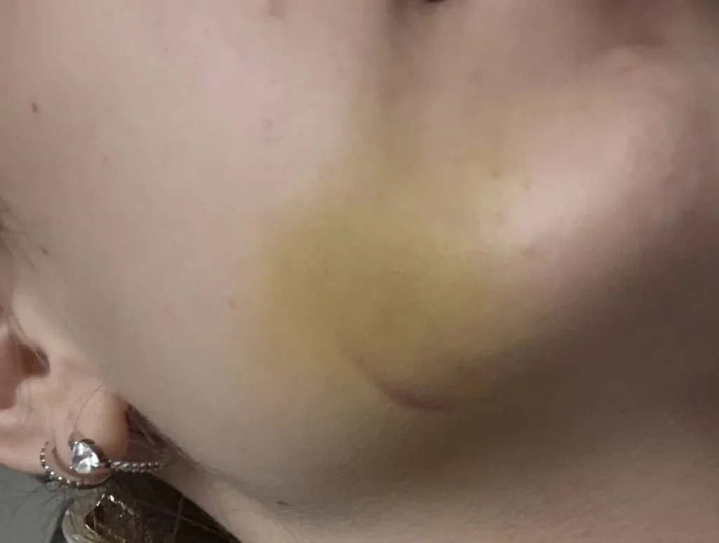 Facial bruising after wisdom tooth extraction during normal postoperative healing