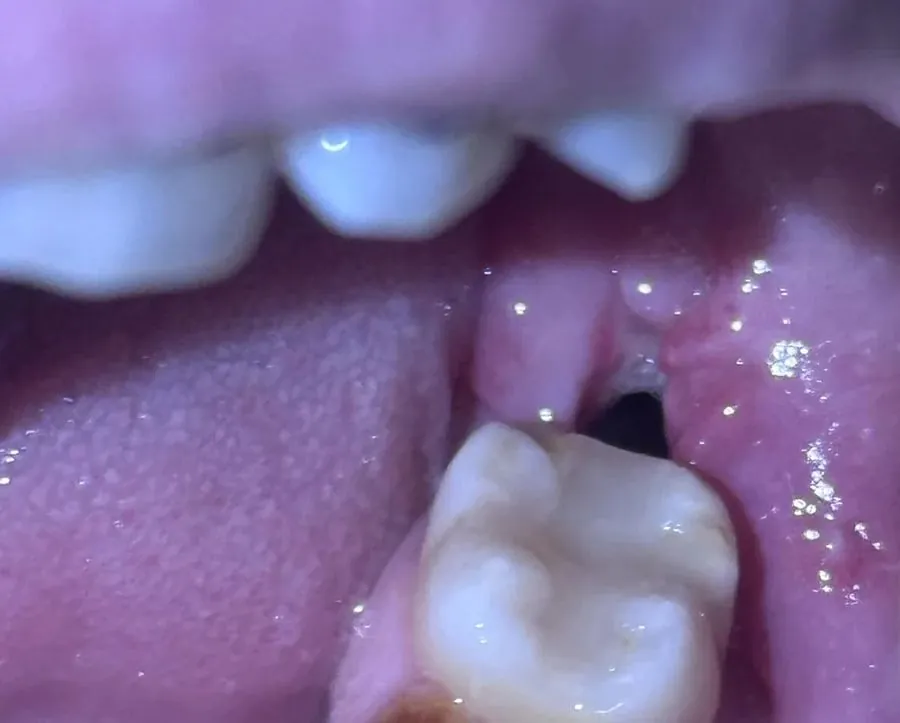 Healing wisdom tooth extraction socket with a dark hole seven days after surgery showing normal bone healing