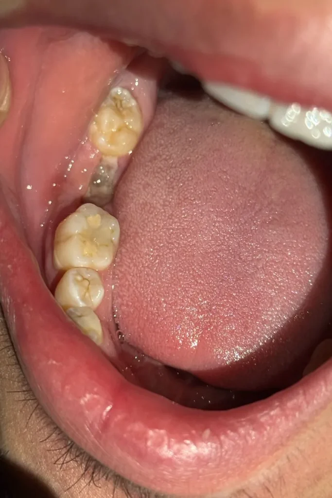 Wisdom tooth extraction site one week after surgery showing normal white healing tissue and granulation tissue