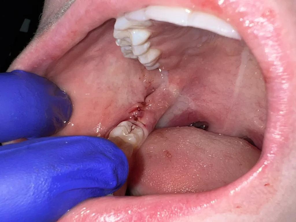 Dissolvable stitches after wisdom tooth extraction surgery during normal healing