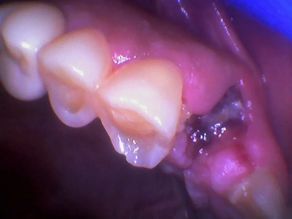 Healing wisdom tooth extraction site showing normal blood clot and granulation tissue during early recovery